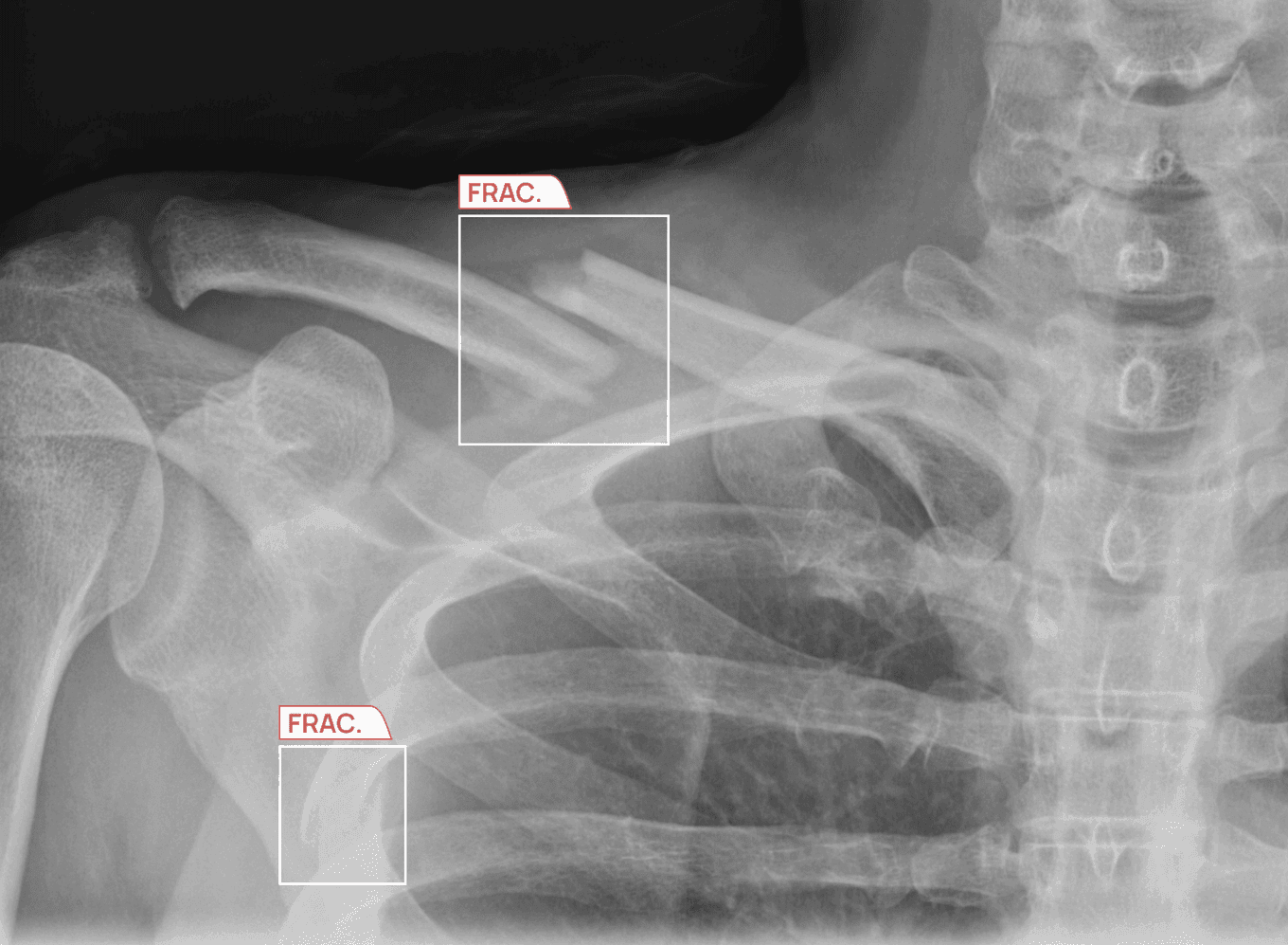 Shoulder and rib X-ray with AI-detected fractures highlighted